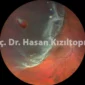 retina yirtigi ile retina dekolmani arasindaki fark nedir 85x85